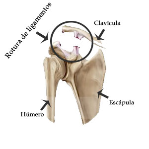 Grado V de una una luxación acromioclavicular